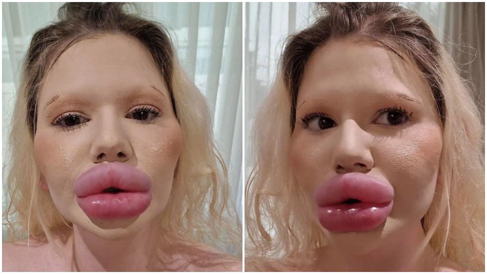 Femeia cu „cele mai mari buze din lume” apelează din nou la injectare! Motivul pentru care nu vrea să se oprească cu intervențiile